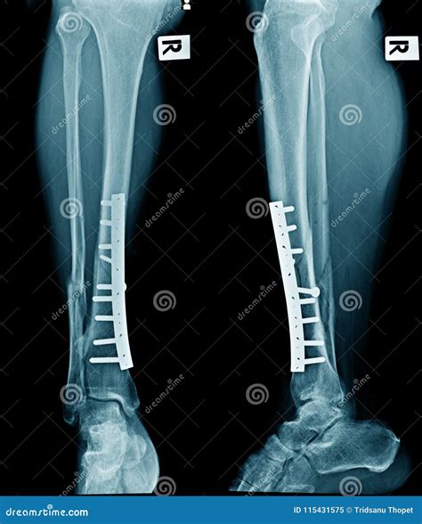 Tibia And Fibula Fracture