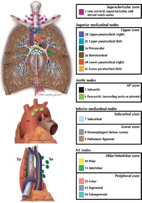 Figure 1 from Revised ESTS guidelines for preoperative mediastinal ...