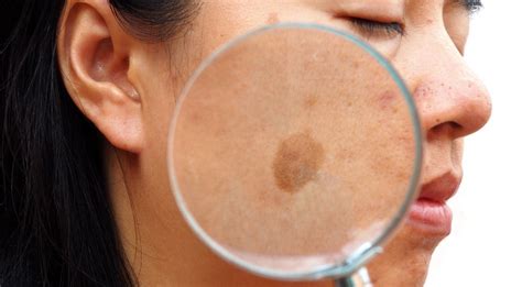 Melasma- Causes, Symptoms, And Diagnosis | Barbara B Jones