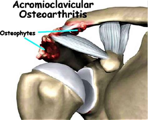 Acromioclavicular joint, acromioclavicular joint injury, separation ...