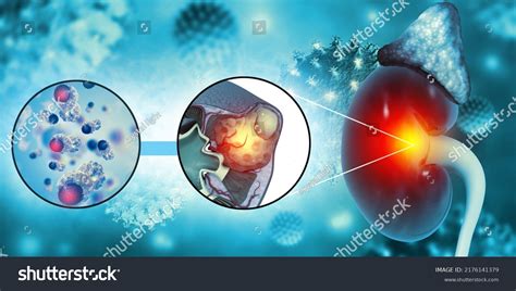 Diagram Showing Different Stages Kidney Cancer3d Stock Illustration ...