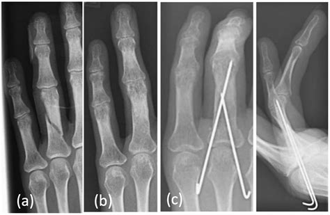 TRAPEZOID ROTATIONAL BONE GRAFT OSTEOTOMY FOR METACARPAL, 51% OFF