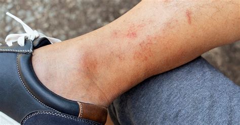 Hives vs. Rash: Identification, Symptoms, Causes, and Treatment