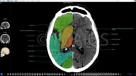 Brain, CT, Anatomy, Cerebral lobes, Ventricles | Brain anatomy ...