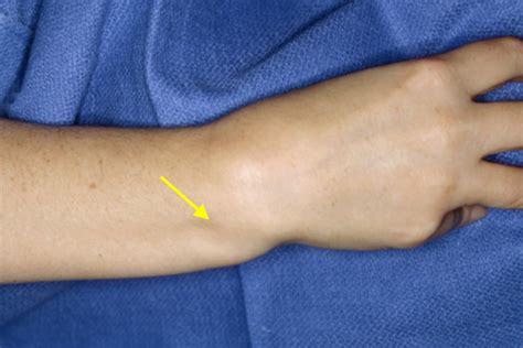 DISLOCATION, WRIST DISTAL RADIAL ULNAR JOINT (DRUJ) | Hand Surgery Resource