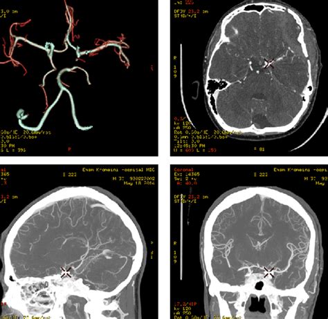 Cerebral Aneurysm Angiogram