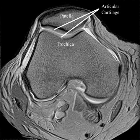 Radiology Anatomy Images : Patellar articular cartillage in MRI Knee ...