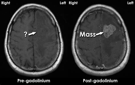 MRI interpretation - Contrast agents