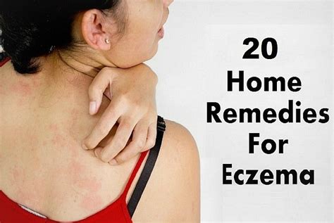 20 Best Natural Home Remedies for Eczema in Adults