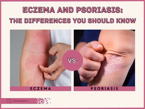 Psoriasis vs. Eczema: How to Tell Them Apart - Remotederm