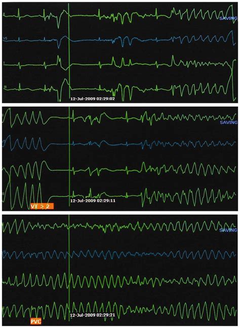 Ventricular Flutter Vs Torsades