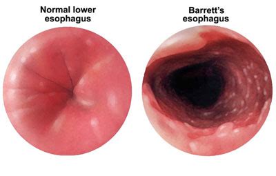 Barretts Esophagus Buffalo NY | Antonino Mannone - Main Gastroenterology