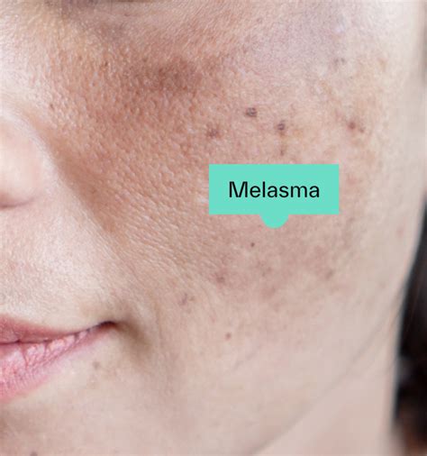 Understanding Melasma: Causes, Symptoms, and Effective Treatments