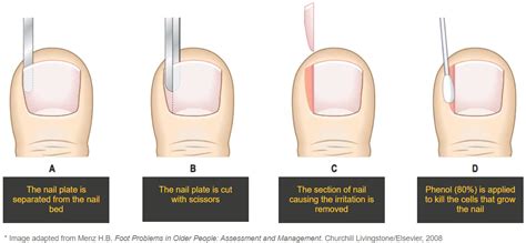 Treatment Options For An Ingrown Toenail - Ask The Nurse Expert