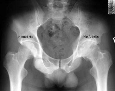 Hip Arthritis | Vancouver Hip Institute | Hip Preservation Vancouver, BC