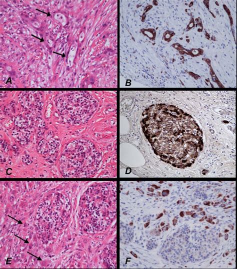 Histology and immunoprofile of pancreatic type adenocarcinoma. The ...