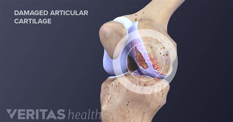 Knee Cartilage Repair, Regeneration, and Replacement