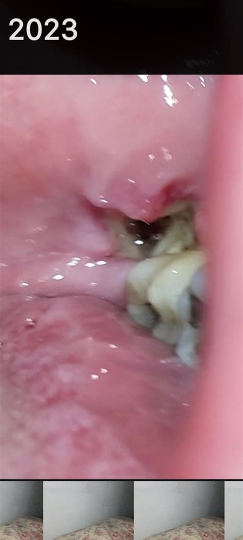 wisdom tooth...dry socket? is this dry socket? : r/WisdomToothRecovery