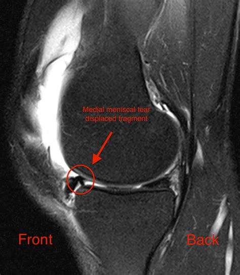 Meniscus Symptoms | Town Center Orthopaedic Associates