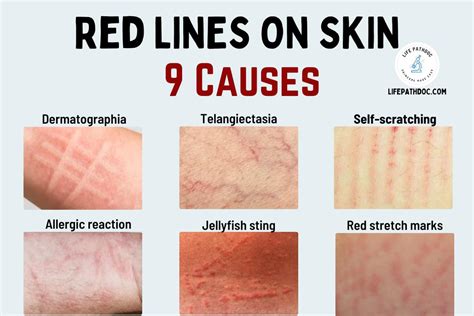 Red Lines on the Skin: 9 Causes, Pictures & Treatment