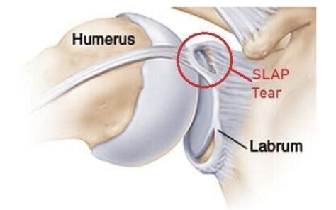 Shoulder Labral Tears - Ohio Healthcare Partners - Akron, OH