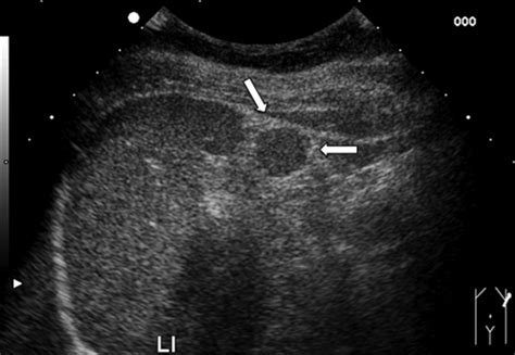 Abnormal Spleen Ultrasound