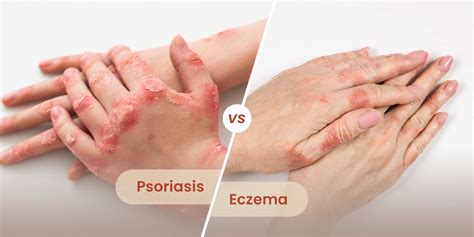 psoriasis vs. eczema - Cure Natural Skin Care