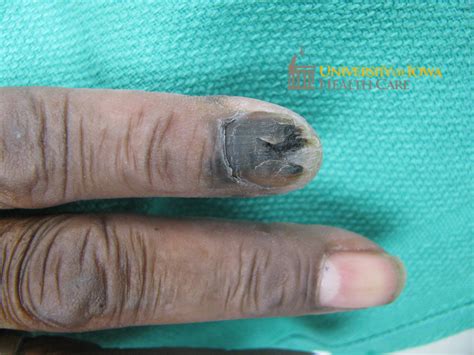 A brown and black plaque on the proximal nail fold extending onto the ...