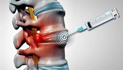 Cervical Epidural Steroid Injection NYC | Injections for Back Pain New York