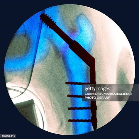 Hip Fracture X Ray Photos and Premium High Res Pictures - Getty Images