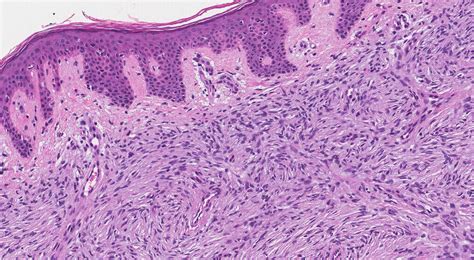 Dermatofibrosarcoma Protuberans Histology