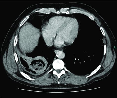 Image of the preoperative CT scan showing the suspect lung abscess ...