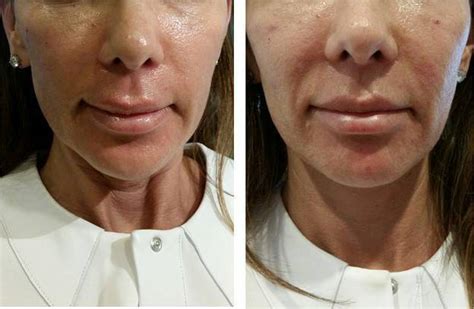 Vampire Facelift Before And After Photos (4) » Facelift: Info, Prices ...