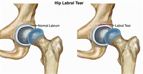 Hip Labral Tear: Sports Medicine Doctor Mesa AZ, Orthopedic Surgeon