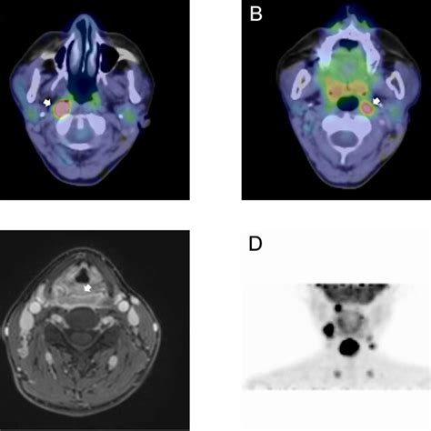 Hypopharyngeal carcinoma with bilateral retropharyngeal lymph node ...