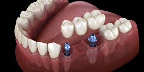 Loose Dental Implant Bridge - Downtown Toronto Dentist