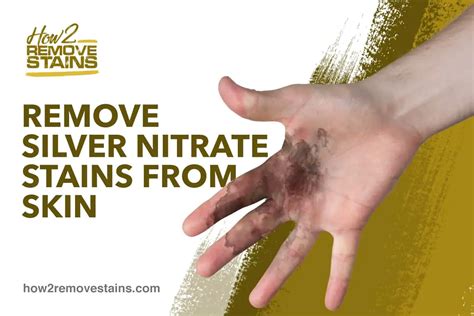 How to Remove Silver Nitrate Stains from Skin [ Detailed Answer ]