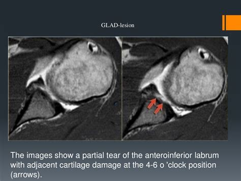 Shoulder labral tears MRI