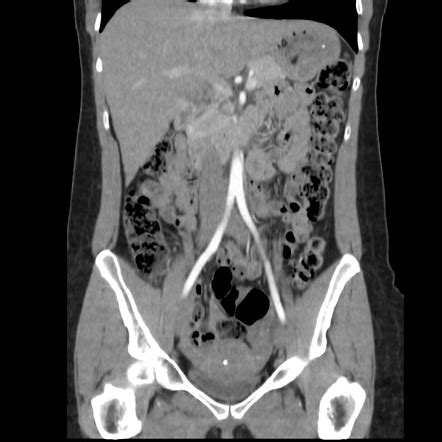 Normal Ct Scan Abdomen