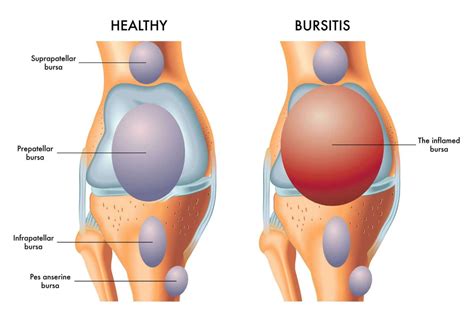 Bursitis: Treatment, Symptoms & Causes | The Feet People Podiatry