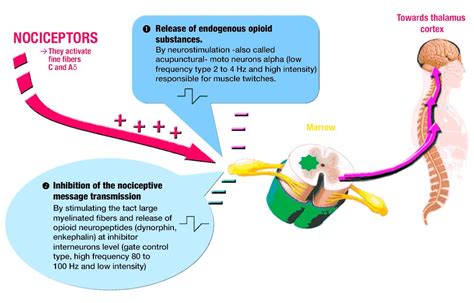 Párbeszéd Sokszavú posztáta Fúró tens neurostimulator kezdődik Póráz ...