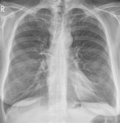 Chest X-ray showing diffuse homogeneous emphysema. | Download ...