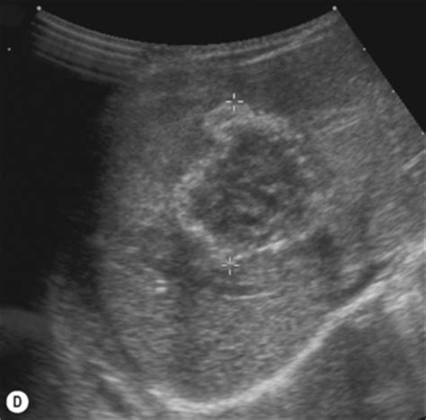 ULTRASOUND FINDINGS OF LIVER HEMANGIOMA - Wroc?awski Informator ...