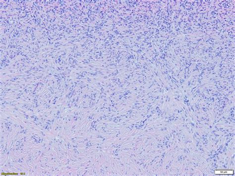 Dermatofibroma Histology