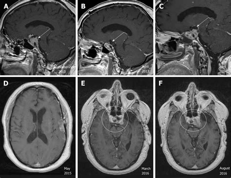 Mri Brain Tumor Pituitary