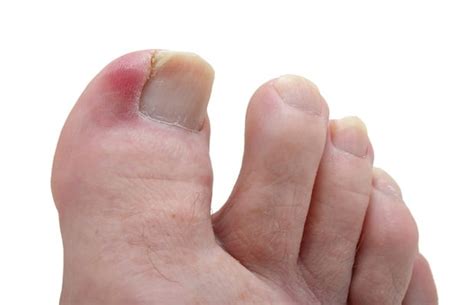 Blister On Big Toe Diabetes - DiabetesWalls