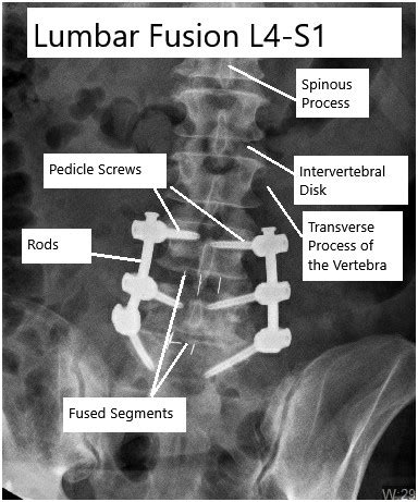 Lumbar Fusion Surgery | Complete Orthopedics | Multiple NY Locations