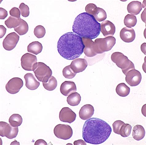 Acute Myelomonocytic Leukemia - 2.