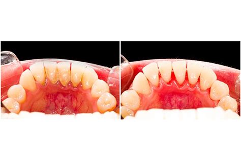 Waxhaw Dentist | The Difference Between Plaque and Tartar