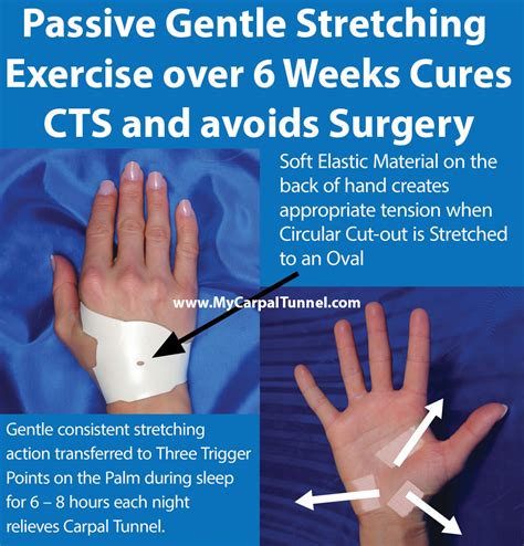 Carpal Tunnel Syndrome Exercises | The Carpal Solution